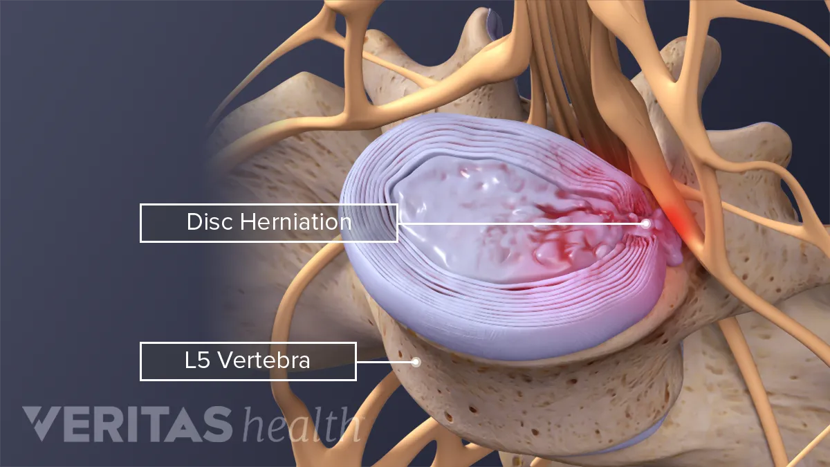 sciatica e radiofrequenza